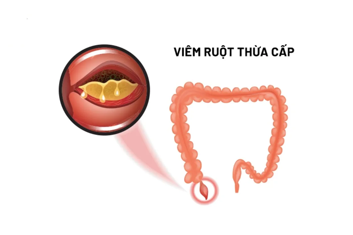 Tác nhân gây bệnh viêm ruột ở trẻ em