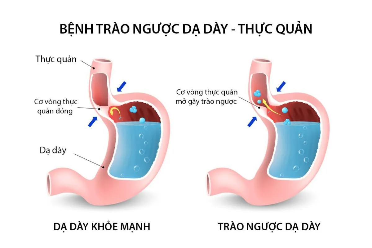 Dấu hiệu trào ngược dạ dày ở trẻ sơ sinh