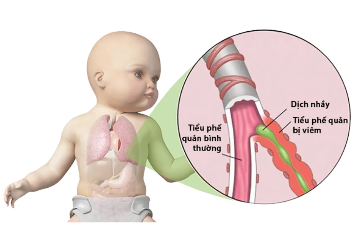 Diễn tiến điển hình của một đợt viêm tiểu phế quản cấp ở trẻ em