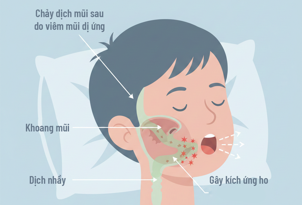 Chảy dịch mũi sau do viêm mũi dị ứng khiến trẻ ho khan về đêm